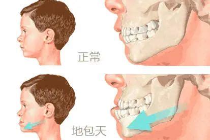 什么是地包天|【口腔健康系列科普】“地包天”的“防”与“治”